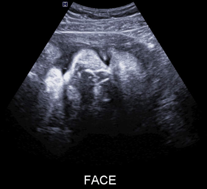 baby face at 36 weeks