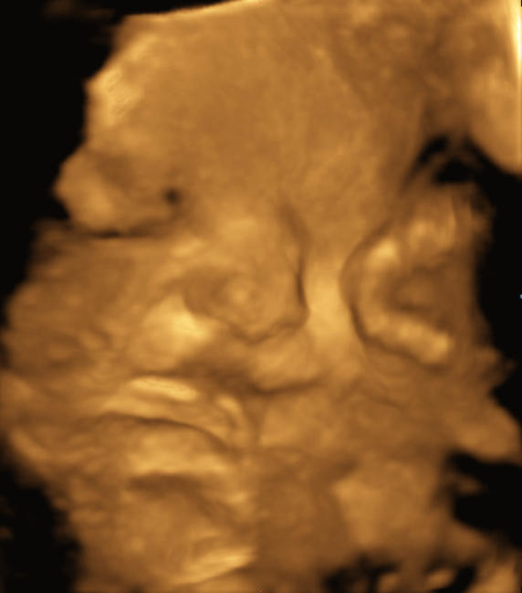 baby face at 36 weeks