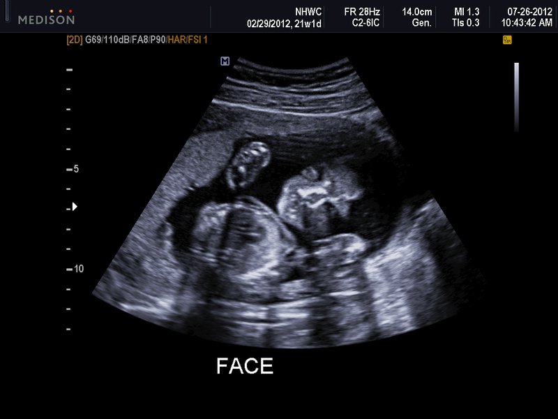 21 week baby ultrasound: face