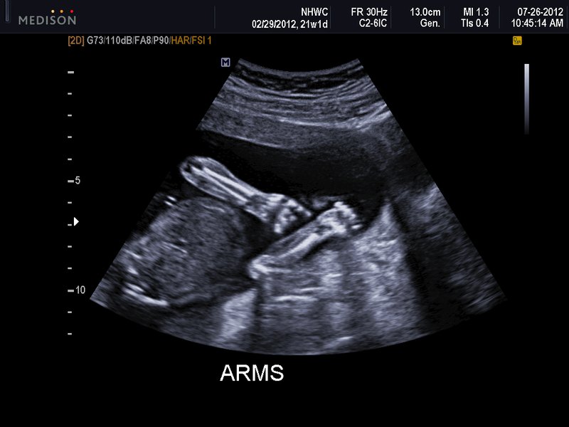 21 week baby ultrasound: arms