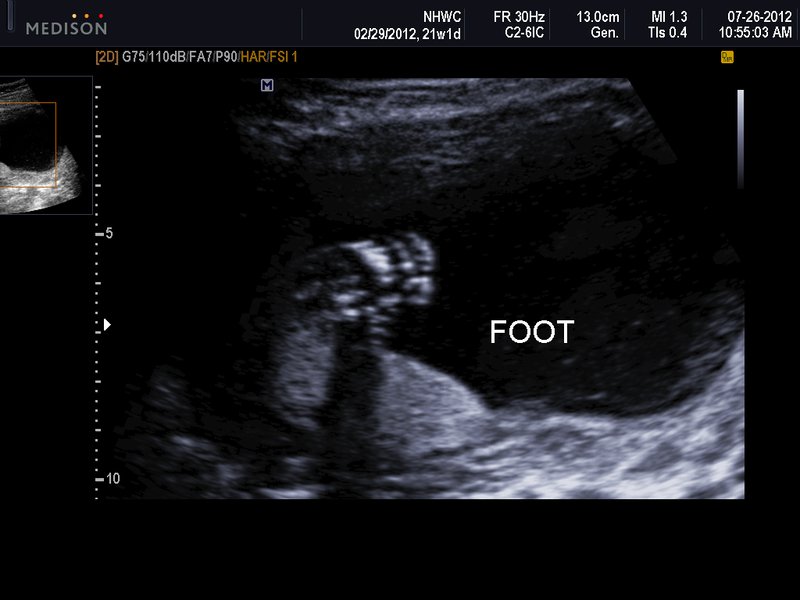 21 week baby ultrasound: foot